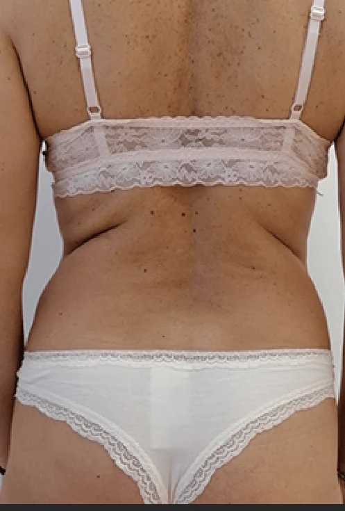 Originalna ADIPOLOGIE fotografija prije tretmana: Leđa / struk